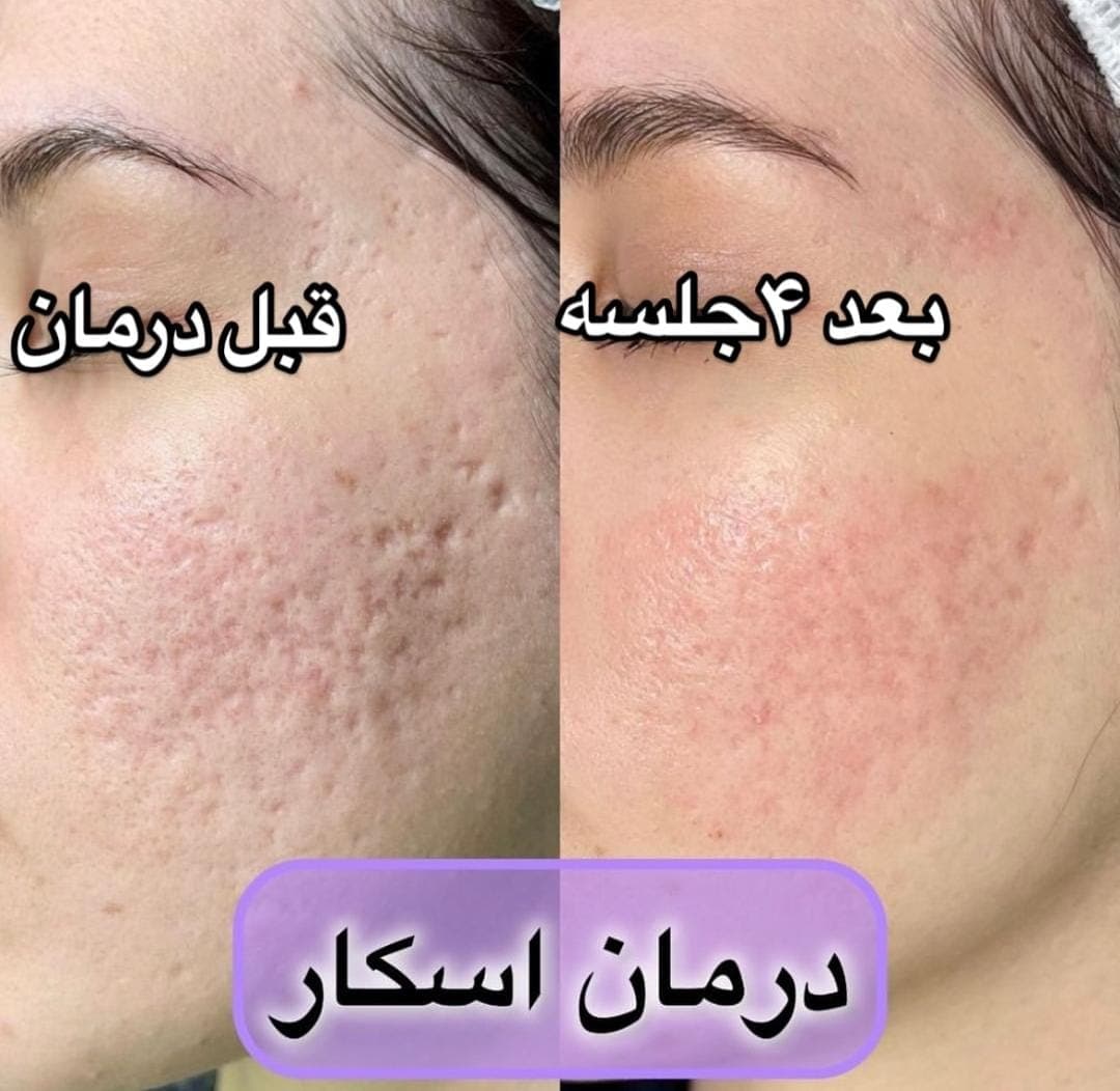 آموزش و درمان جوش و اسکار مرضیه سجادیان در کرمانشاه