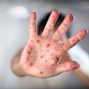 آبله میمون افراد بالای ۵۱ سال را مبتلا نمی‌کند!