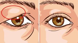 جراحی پلک یا بلفاروپلاستی چیست ؟