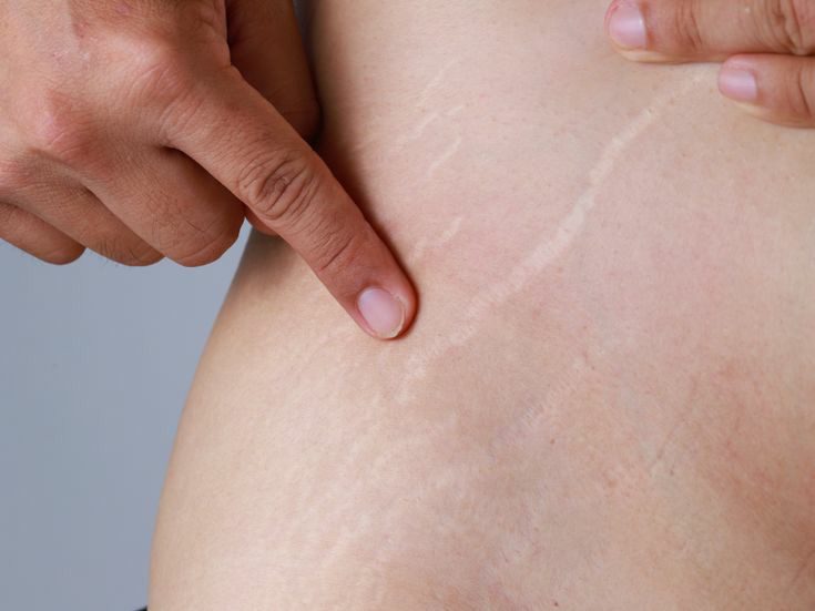 راههای مقابله با ترکهای پوستی
