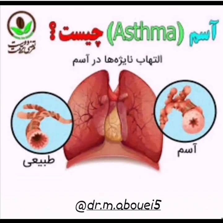 دکتر محمد ابوئی درمان انواع بیماری های تنفسی  در یزد