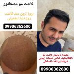 کلینیک تخصصی کاشت مو رویش در تبریز