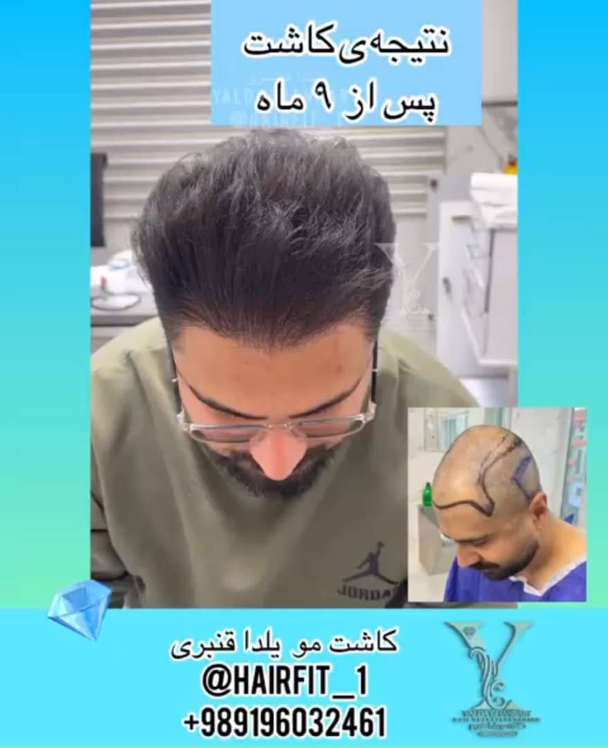 کاشت مو و ابرو و ریش یلدا قنبری در سعادت آباد تهران ، آدرس کاشت مو و ابرو و ریش یلدا قنبری در سعادت آباد تهران ، ایران مشاغل سامانه برتر ثبت مشاغل کشور