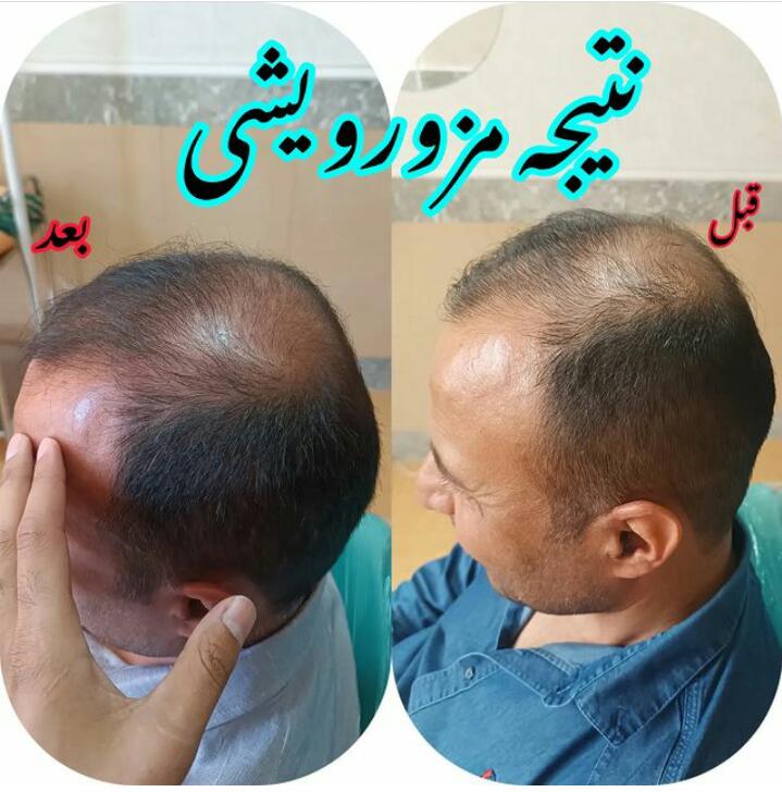 خدمات کاشت مو و ابرو کلینیک مورویان در مهاباد آذربایجان غربی ، آدرس خدمات کاشت مو و ابرو کلینیک مورویان در مهاباد آذربایجان غربی ، ایران مشاغل سامانه برتر ثبت مشاغل کشور