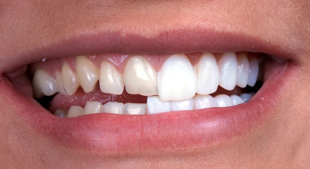 Dental Crown چیست؟ ، ایران مشاغل سامانه برتر ثبت مشاغل کشور