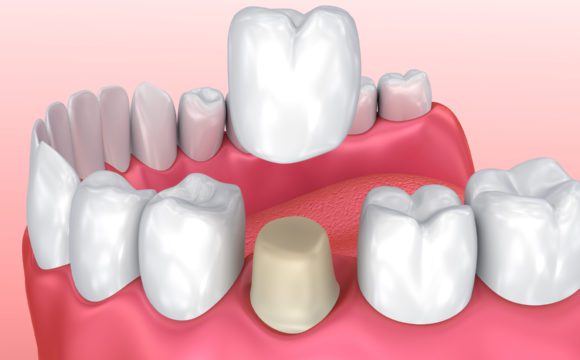 بیلداپ یا بازسازی دندان چیست؟ ، ایران مشاغل سامانه برتر ثبت مشاغل کشور