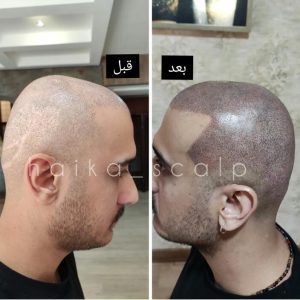 مرکز تخصصی میکرواسکالپ و اسکالپ سر و اسکالپ اسپرت هایکا در شیراز ، آدرس مرکز تخصصی میکرواسکالپ و اسکالپ سر و اسکالپ اسپرت هایکا در شیراز ،مرکز تخصصی میکرواسکالپ و اسکالپ سر و اسکالپ اسپرت در شیراز ، ایران مشاغل سامانه برتر ثبت مشاغل کشور