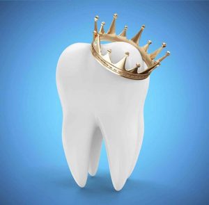 تاج گذاشتن روی دندان‌ها چگونه است؟ ، ایران مشاغل سامانه برتر ثبت مشاغل کشور