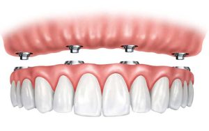تفاوت دندان متحرک و مصنوعی چیست ؟