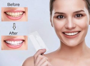 بلیچینگ نواری چیست؟