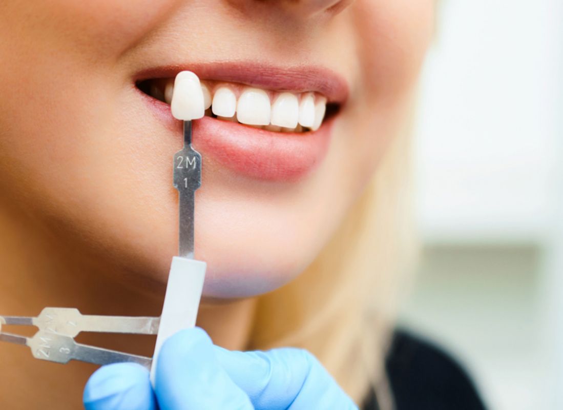 Dental Crown چیست؟ ، ایران مشاغل سامانه برتر ثبت مشاغل کشور