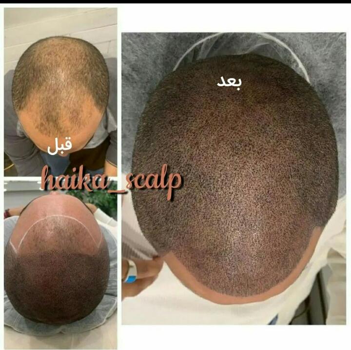 مرکز تخصصی میکرواسکالپ و اسکالپ سر و اسکالپ اسپرت هایکا در شیراز ، آدرس مرکز تخصصی میکرواسکالپ و اسکالپ سر و اسکالپ اسپرت هایکا در شیراز ، ایران مشاغل سامانه برتر ثبت مشاغل کشور