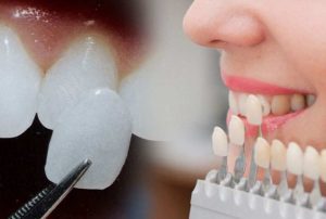 Dental Crown چیست؟