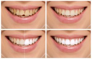 باندینگ دندان‌ چیست؟