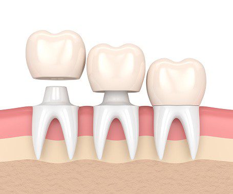 تاج گذاشتن روی دندان‌ها چگونه است؟ ، ایران مشاغل سامانه برتر ثبت مشاغل کشور