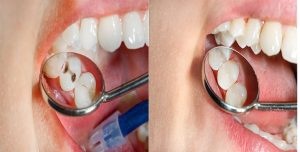 روش پر کردن دندان ها چگونه است؟
