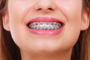 ارتودنسی ثابت چیست و انواع آن کدام است؟