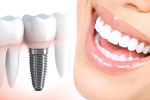 ایمپلنت دندان چیست؟