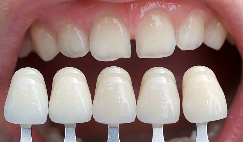 Dental Crown چیست؟ ، ایران مشاغل سامانه برتر ثبت مشاغل کشور