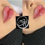 تزریق ژل و بوتاکس دکتر مهسا فتحی در ارومیه