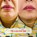 تزریق ژل و بوتاکس دکتر مهسا فتحی در ارومیه