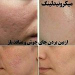 آموزش و خدمات تخصصی زیبایی و فشیال بوتاکس و مزونیدلینگ زمرد در شیراز