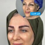 مرکز کاشت مو و ابرو ملیسا در زعفرانیه