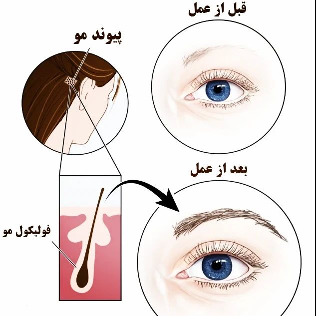 آموزش و خدمات کاشت مو و ابرو عباس زاده در تبریز ، آدرس آموزش و خدمات کاشت مو و ابرو عباس زاده در تبریز ، ایران مشاغل سامانه برتر ثبت مشاغل کشور