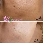 خدمات تخصصی فشیال و پاکسازی پوست صدیقه خیرمند در رفسنجان