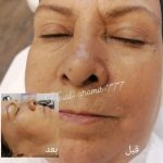 خدمات تخصصی فشیال و پاکسازی پوست صدیقه خیرمند در رفسنجان