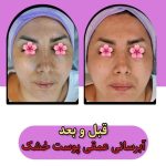 خدمات تخصصی پاکسازی پوست و فیشیال صورت شادی ملکشاهی در اصفهان