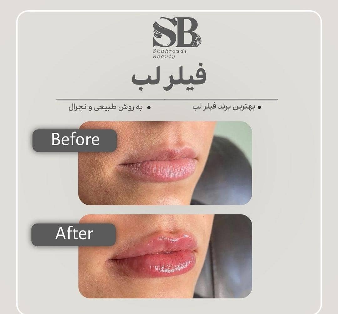 خدمات تخصصی تزریق فیلر لب روسی شاهرودی طب در سعادت آباد تهران ، آدرس خدمات تخصصی تزریق فیلر لب روسی شاهرودی طب در سعادت آباد تهران ، ایران مشاغل سامانه برتر ثبت مشاغل کشور