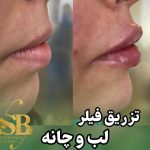 خدمات تخصصی تزریق فیلر لب روسی شاهرودی طب در سعادت آباد تهران