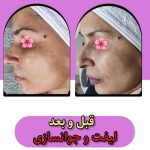 خدمات تخصصی پاکسازی پوست و فیشیال صورت شادی ملکشاهی در اصفهان