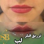 خدمات تخصصی تزریق فیلر لب روسی شاهرودی طب در سعادت آباد تهران