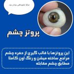 ساخت و طراحی پروتز چشم ارتو‌پد فنی یزدان در یزد