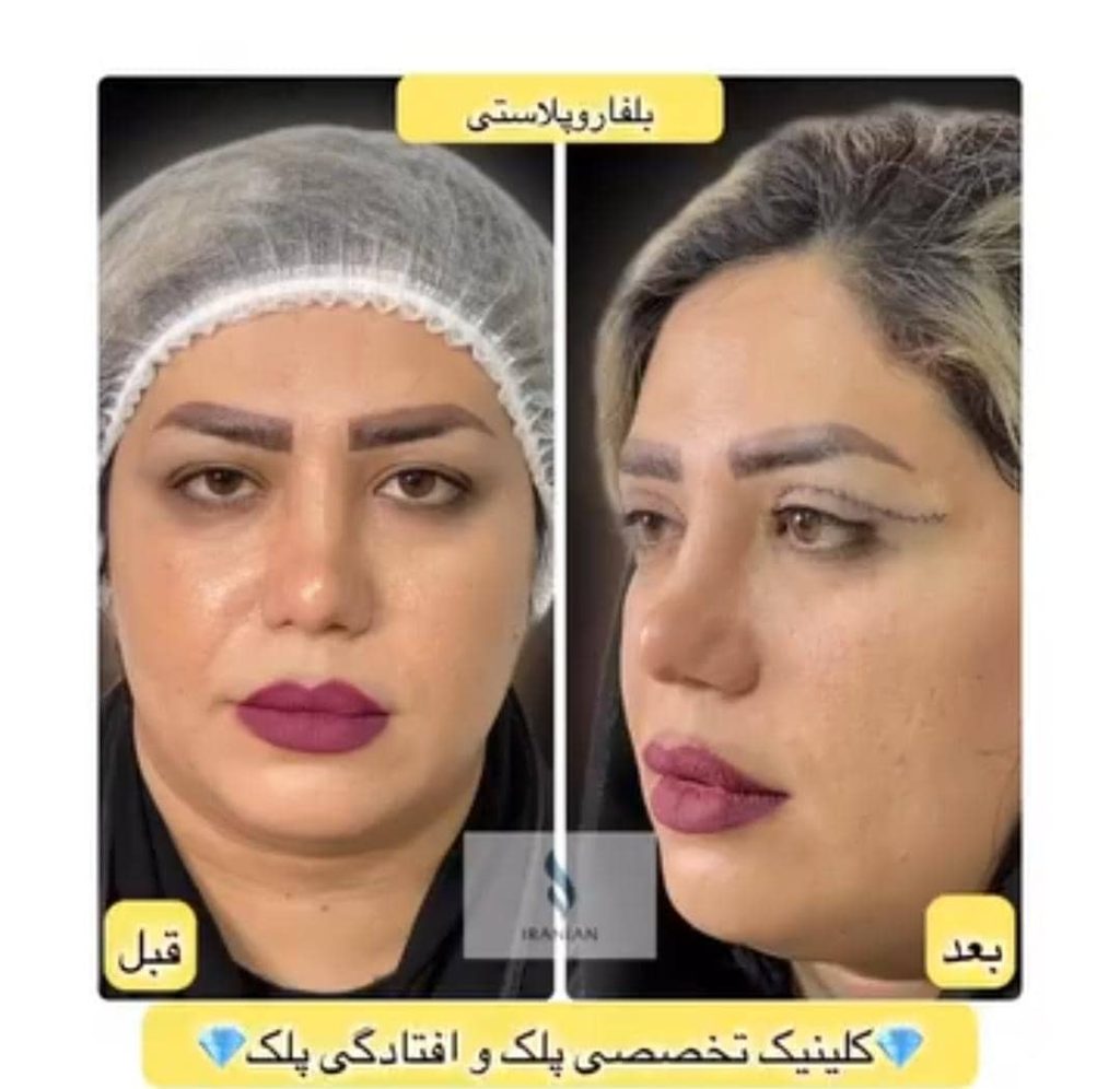 کلینیک تخصصی جراحی پلک ایرانیان در تهران