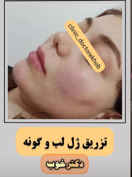 تزریق ژل لب و گونه - دکتر خوب