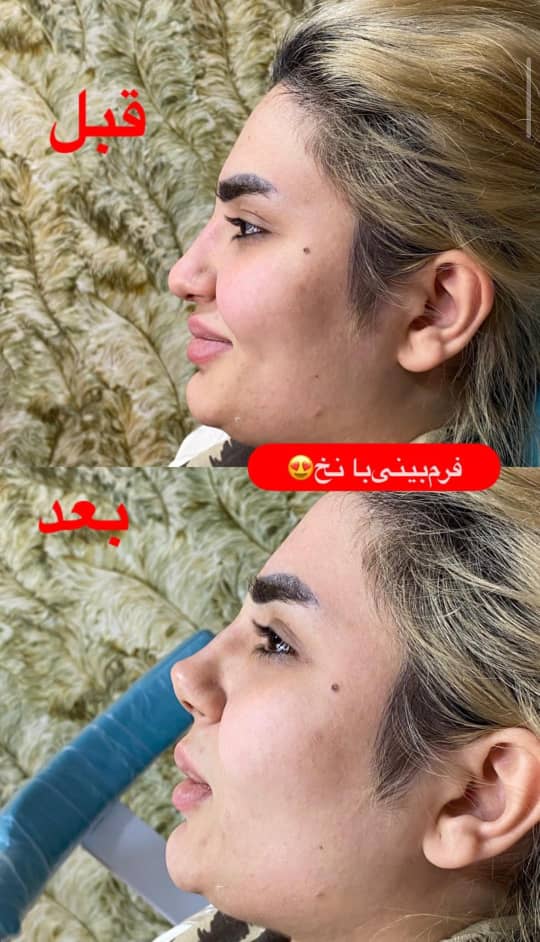 فرم بینی با نخ - دکتر مهسا فتحی