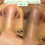 آموزش و خدمات تخصصی پاکسازی پوست و فیشال مهنا پاشا در ساری