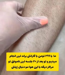 مطب vip لیزر موهای زائد ونوس در سه راهی ولیعصر تبریز