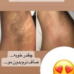 مطب vip لیزر موهای زائد ونوس در سه راهی ولیعصر تبریز