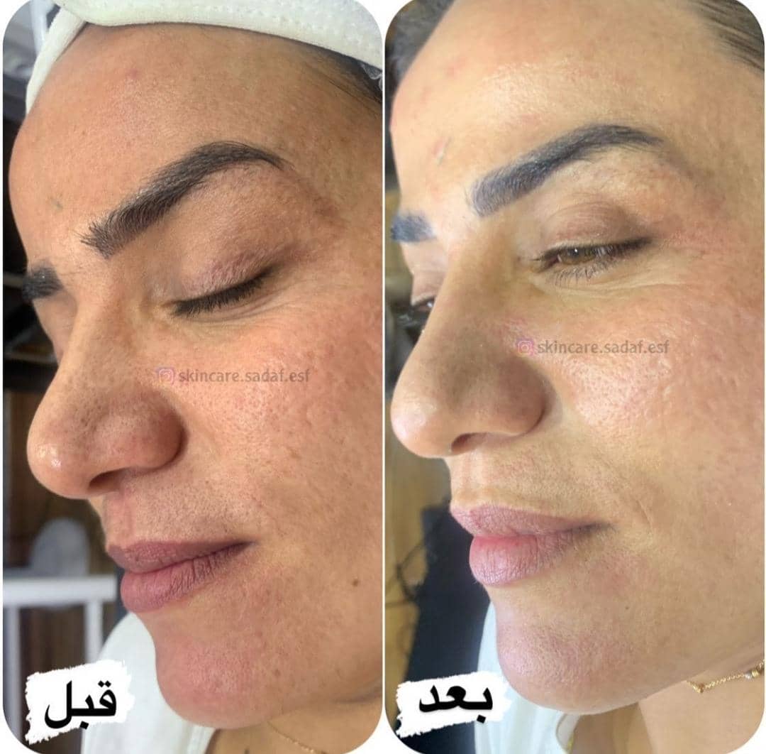 آموزش و خدمات تخصصی پاکسازی پوست صدف زنگنه در اصفهان