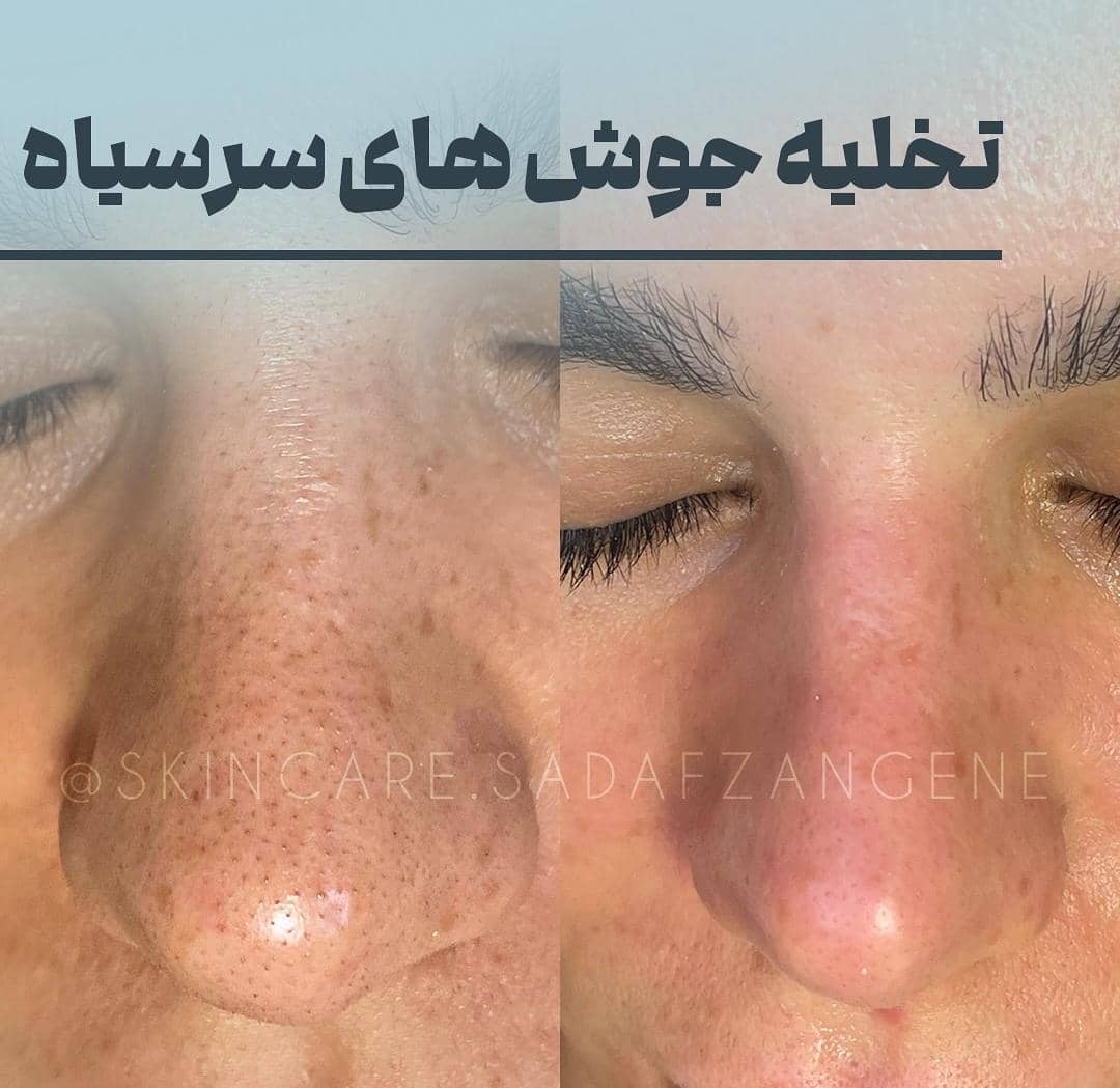 آموزش و خدمات تخصصی پاکسازی پوست صدف زنگنه در اصفهان