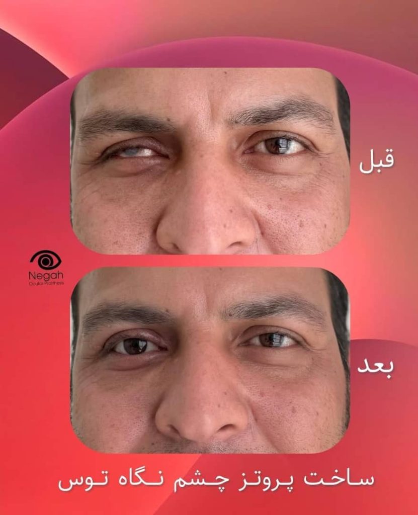 طراحی و ساخت تخصصی پروتز چشم نگاه توس در مرکز مشهد
