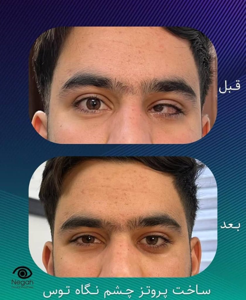 طراحی و ساخت تخصصی پروتز چشم نگاه توس در مرکز مشهد