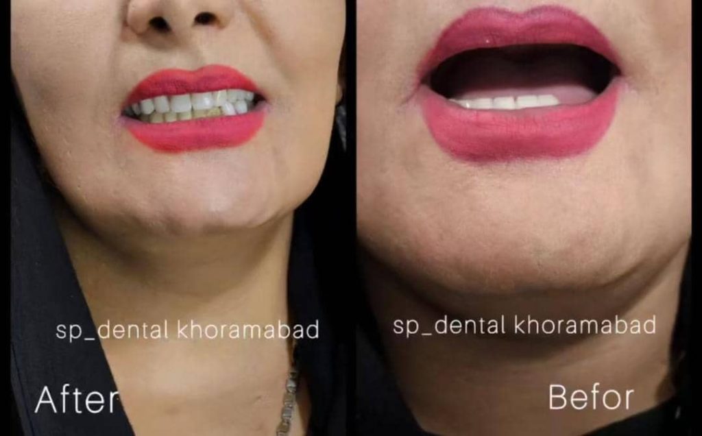 مرکز پروتز متحرک دندان اسپی دنتال در انقلاب خرم آباد