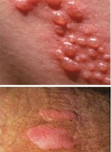 نوبت دهی درمان زگیل تناسلی زینب بهاروند خرم آباد