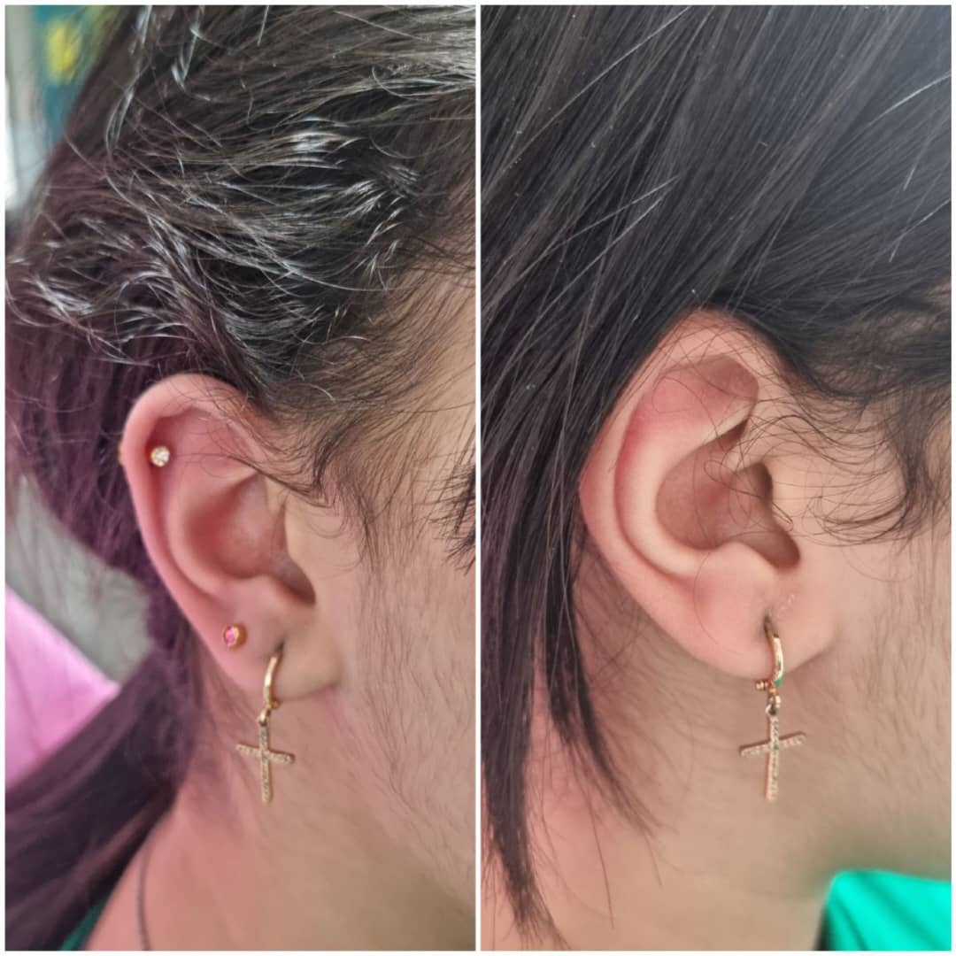 مطب تخصصی رفع ضایعات پوستی و سوراخ کردن گوش دکتر عسکری در سرگل رشت