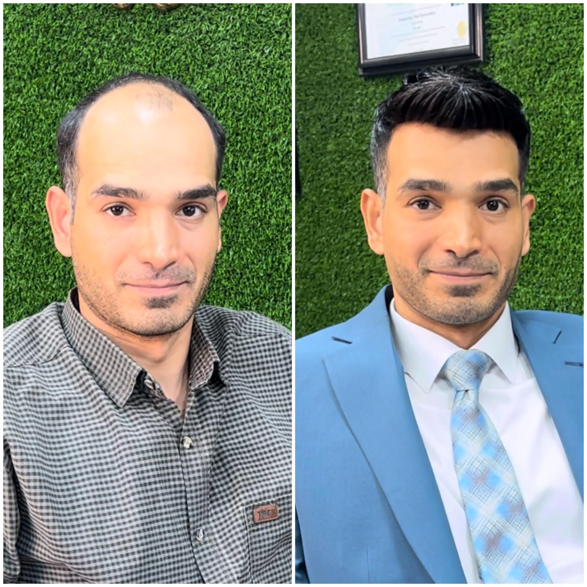 مرکز تخصصی vip پروتز مو علیرام استایل در شهید بهشتی لاهیجان